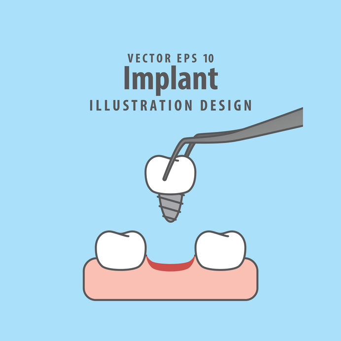 Implant illustration vector on blue background. Dental concept.