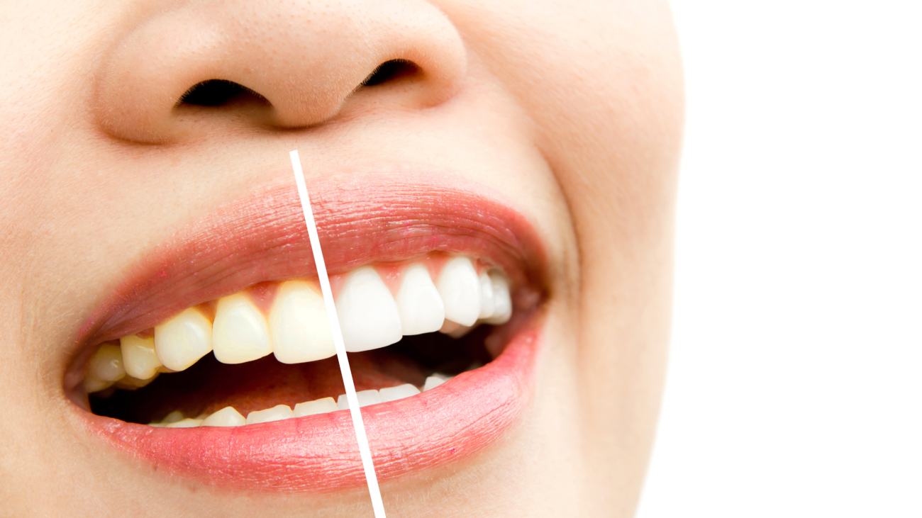 woman teeth before and after whitening. Over white background