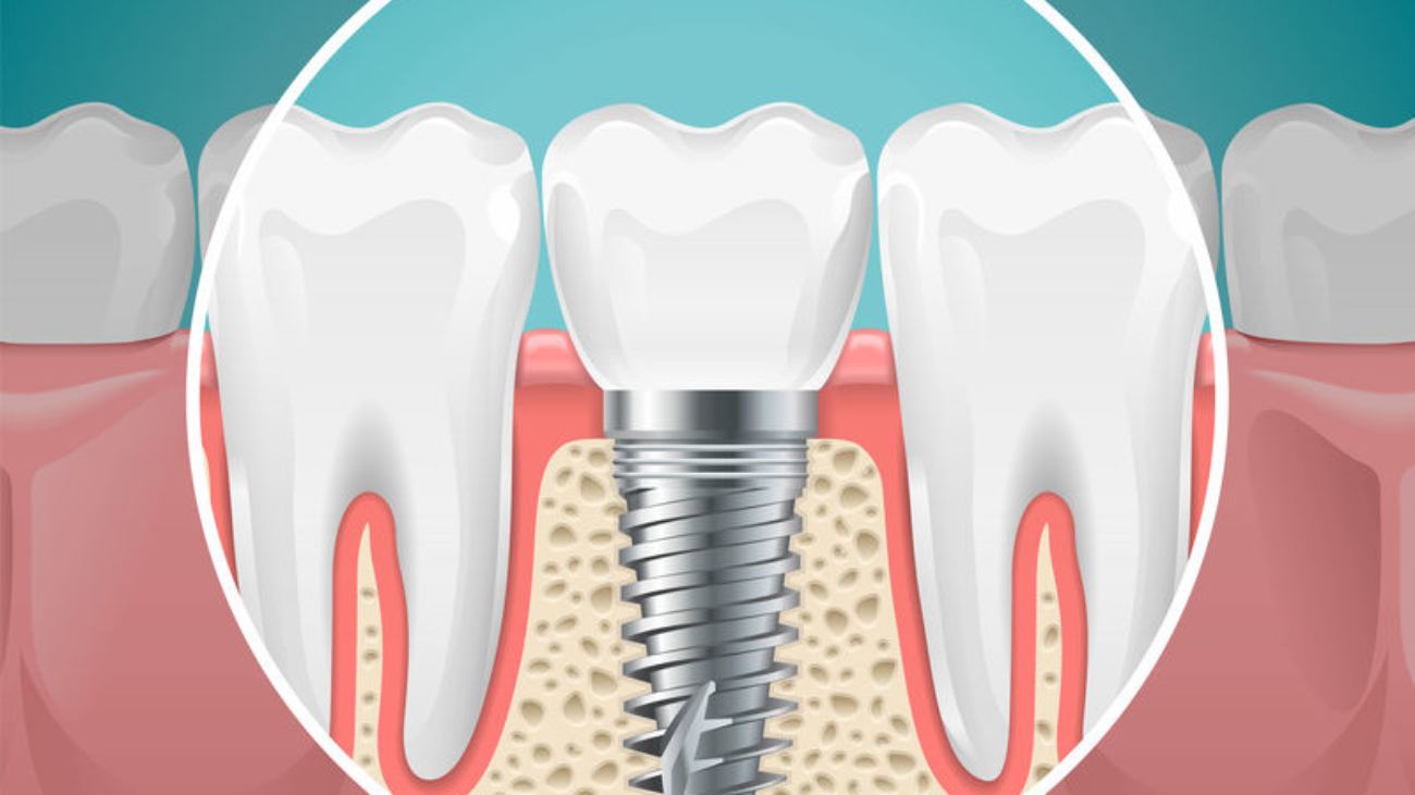 Stomatology illustrations. Dental implants and healthy teeth. Vector health tooth and implant stomatology, dentistry installation and fixture